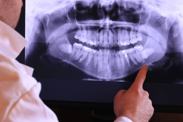 Best Dental Abscess Treatment in Old Fig Garden, CA